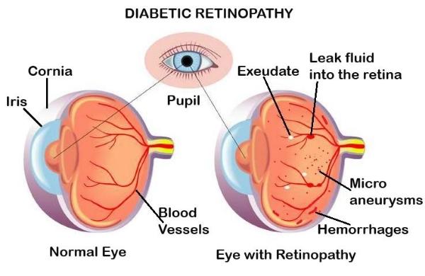 Diabetic Retinopathy Diagnosed