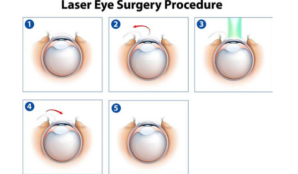 Lasik eye surgery procedure